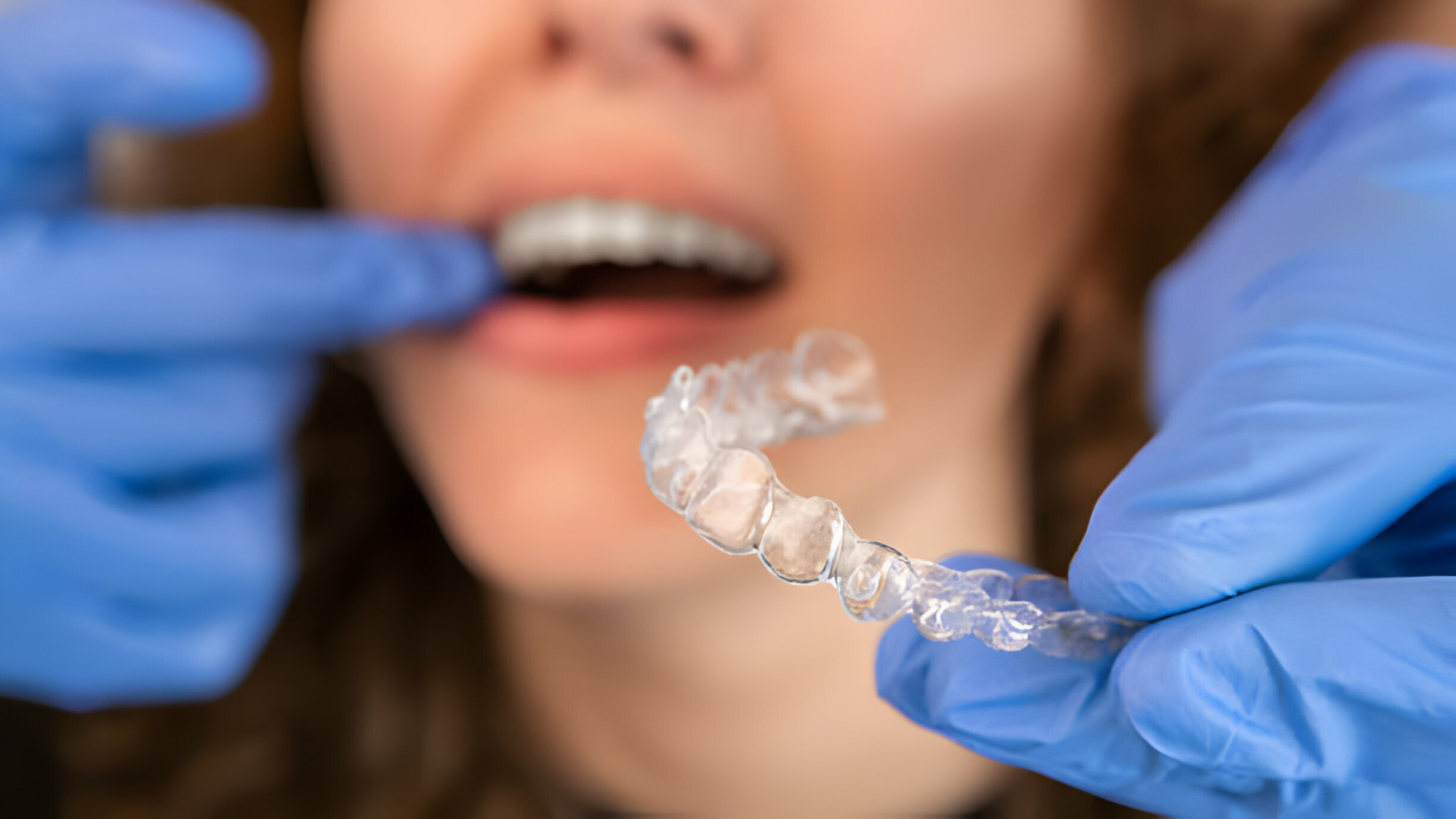 How Does Invisalign Work? A Comprehensive Guide_2