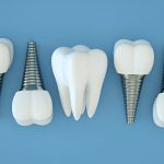 Dental Implant Risks: Common Issues and Their Solutions_FI