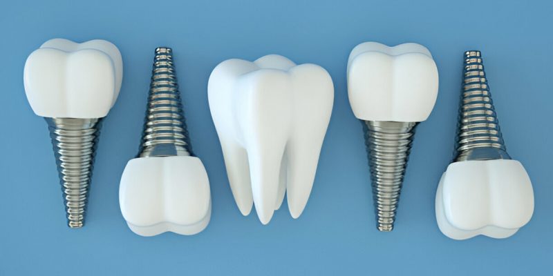 Dental Implant Risks: Common Issues and Their Solutions_FI