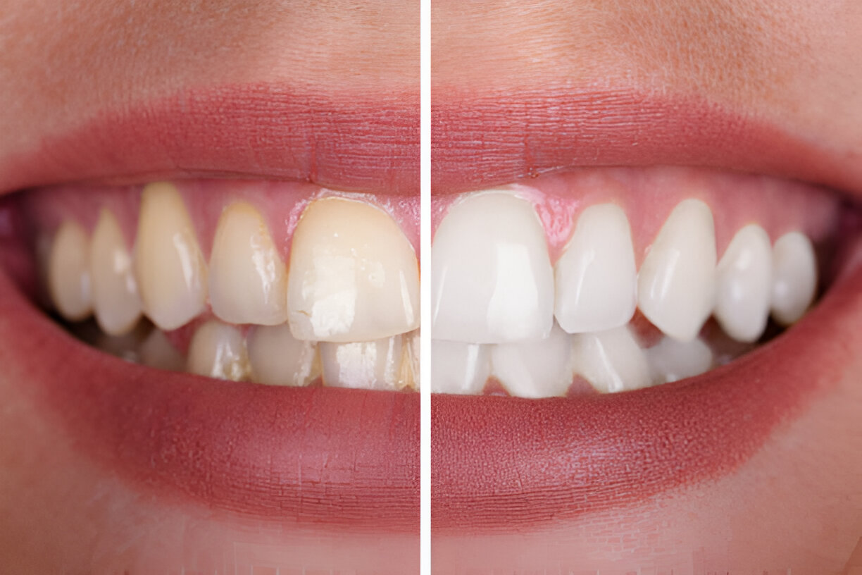 Navarro Dental Corsicana TX: Your Trusted Clinic for Teeth Whitening in Texas_2