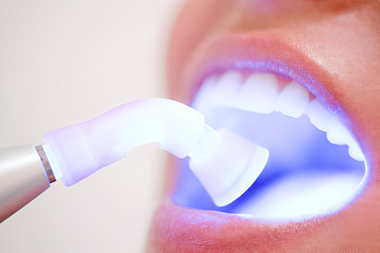 Navarro Dental Corsicana TX: Your Trusted Clinic for Teeth Whitening in Texas_3