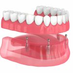 Navarro Dental Center: Your Trusted Provider for Full and Partial Dentures in Corsicana, Texas_FI