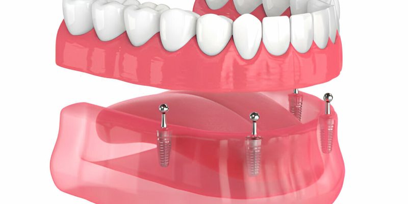 Navarro Dental Center: Your Trusted Provider for Full and Partial Dentures in Corsicana, Texas_FI